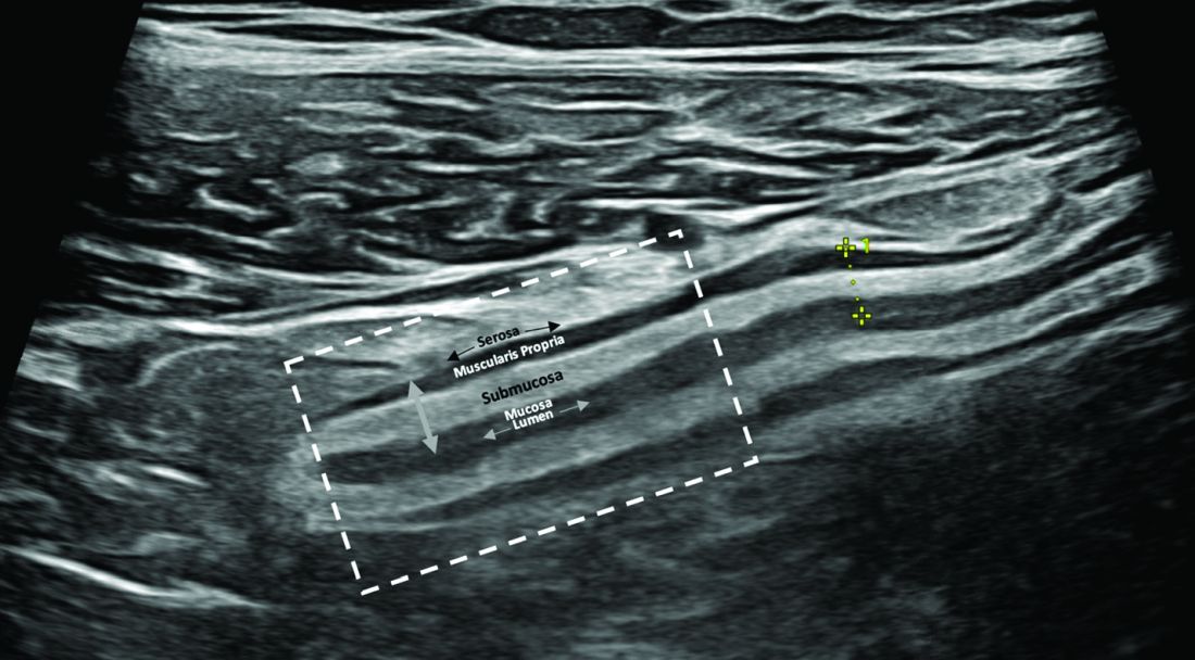 GI And Hepatology News Integrating Intestinal Ultrasound Into GI And Hepatology News Integrating Intestinal Ultrasound Into