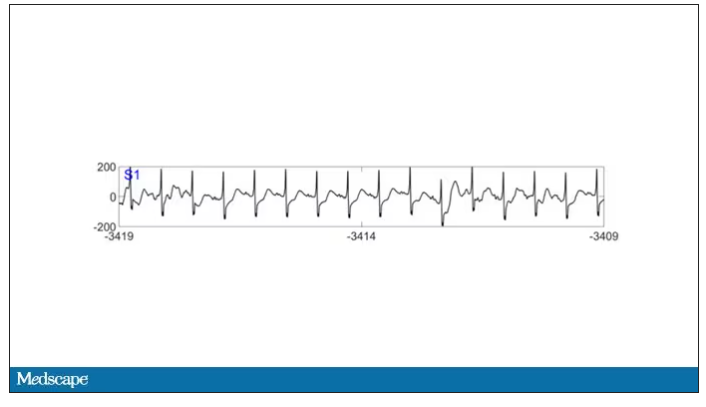 EEG heart rhythm