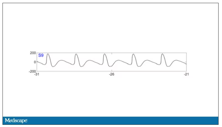 EEG heart rhythm