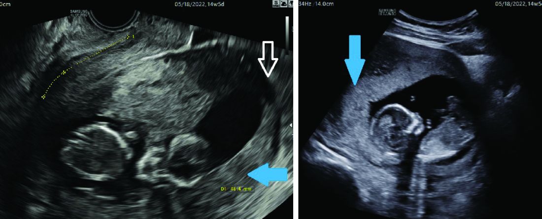 Figure 1 from Acute Urinary Retention Due to an Incarcerated Retroverted  Gravid Uterus