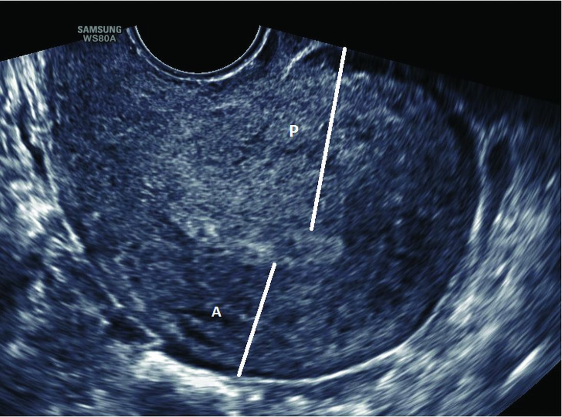 Investigating the etiology of recurrent pregnancy loss | MDedge ObGyn