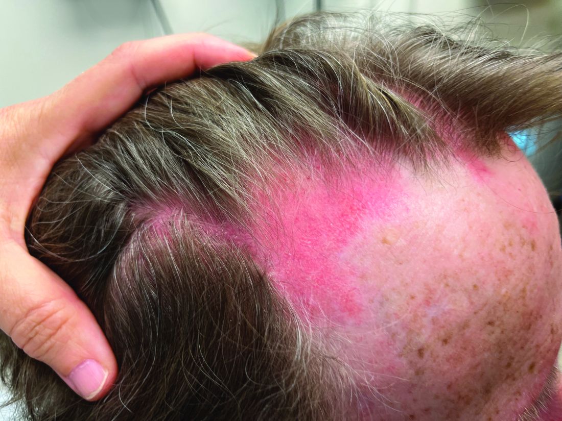 A 75-year-old White woman presented with diffuse erythema, scale, and ...