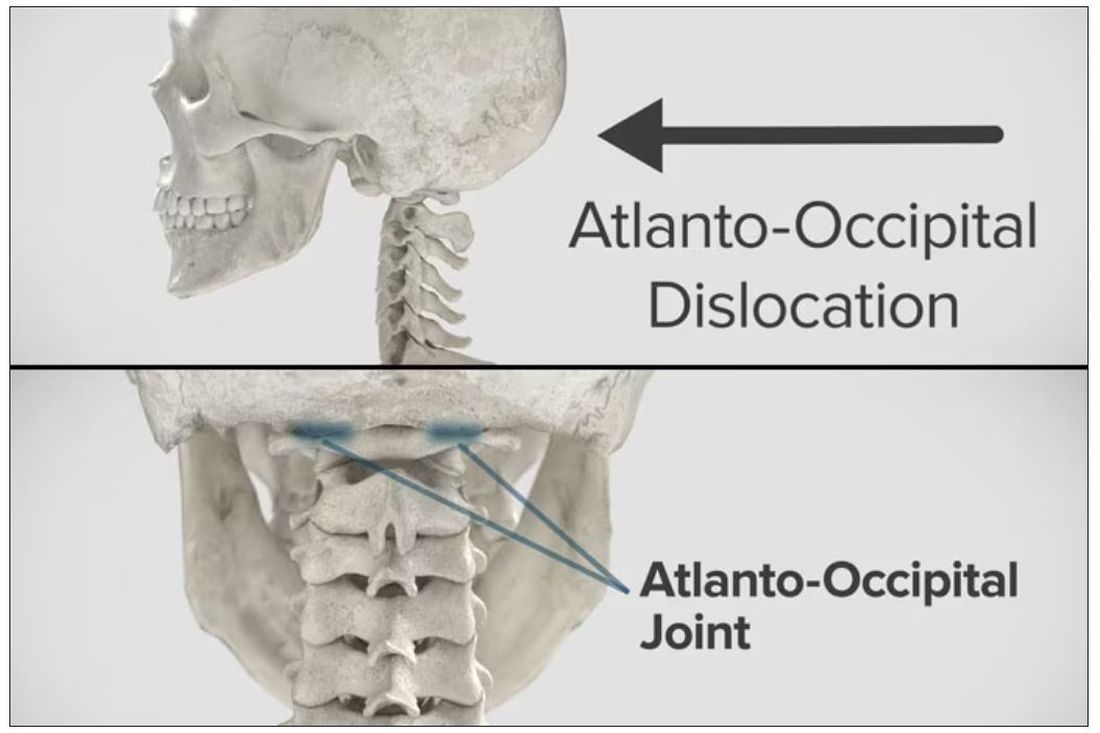 Diagram of atlanto-occipital dislocation