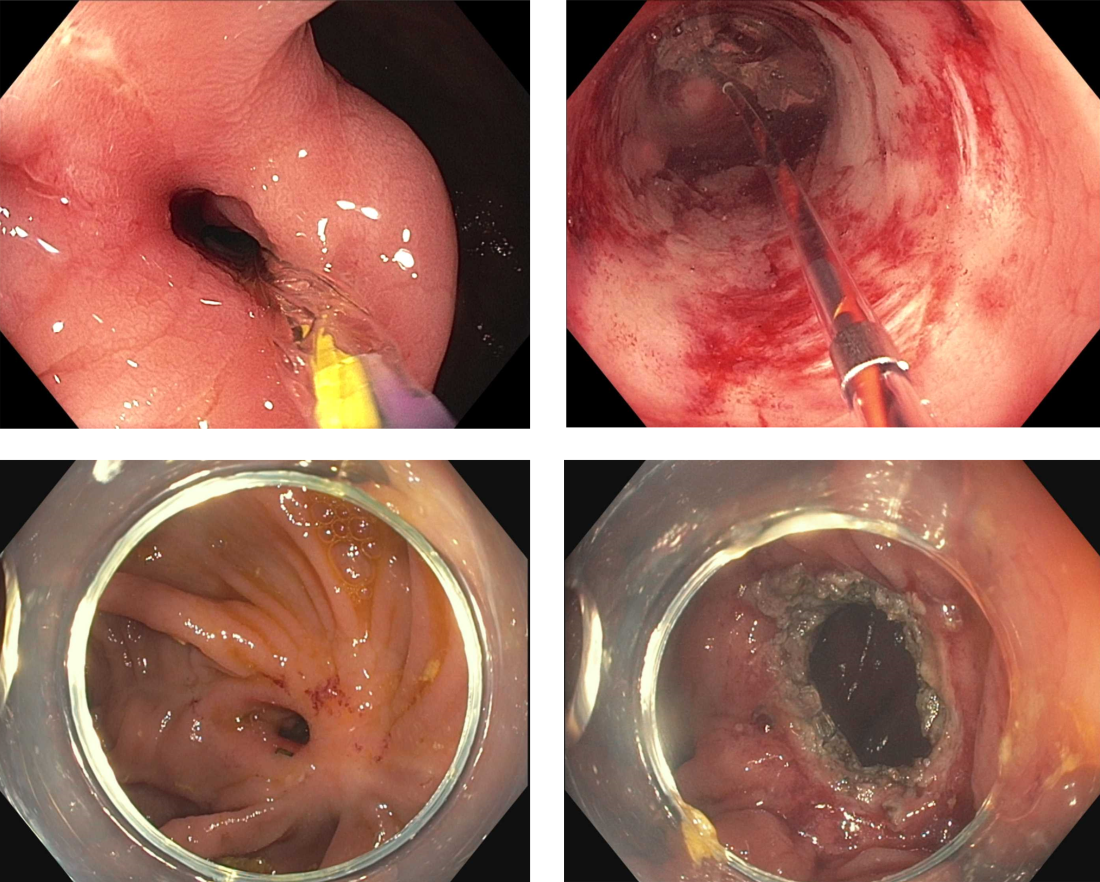 Short clinical review, endoscopic therapy of Crohn's strictures.