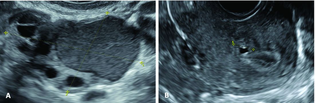 Figure 1: Endometrioma and adenomyosis