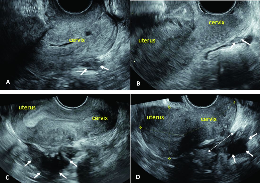 Figure 2: Posterior deep infiltrating endometriosis (DIE)