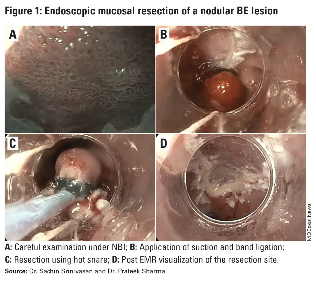 Figure 1. Endoscopic mucosal resection of a nodular BE lesion