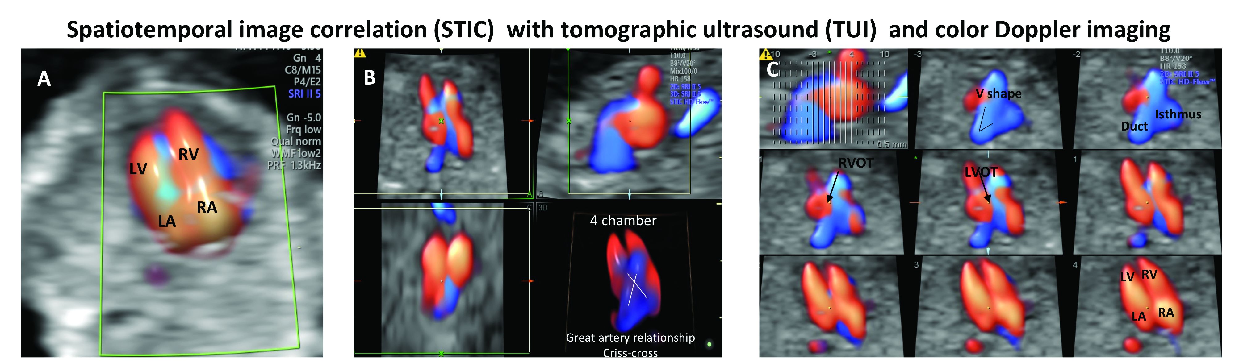 a) Identification of the four-chamber view b) 4-D volume acquisition with STIC and color Doppler imaging c) TUI analysis (offline) with four-chamber view as starting plane