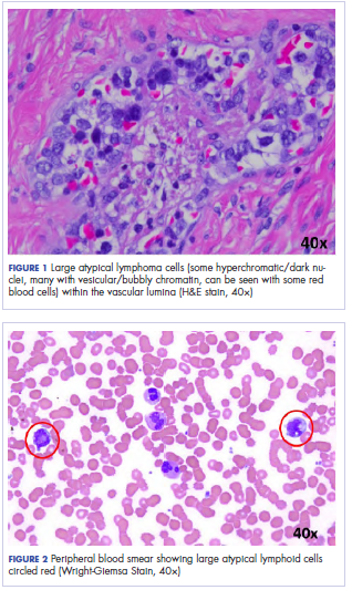 Intravascular Large B Cell Lymphoma An Elusive Diagnosis With Challenging Management Mdedge Hematology And Oncology