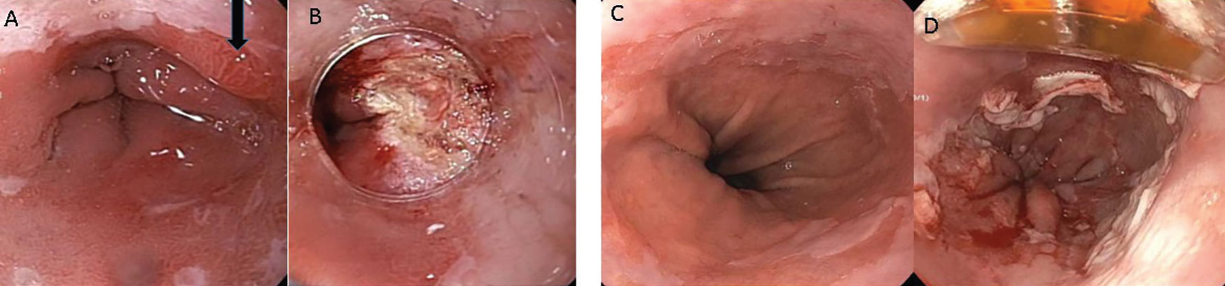 Current Management Of Barrett Esophagus And Esophageal Adenocarcinoma Current Management Of Barrett Esophagus And Esophageal Adenocarcinoma
