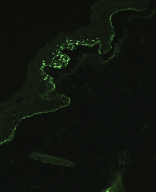 Mouse monoclonal antibodies to type VII collagen followed by goat anti-mouse IgG–fluorescein isothiocyanate conjugate (original magnification ×200).