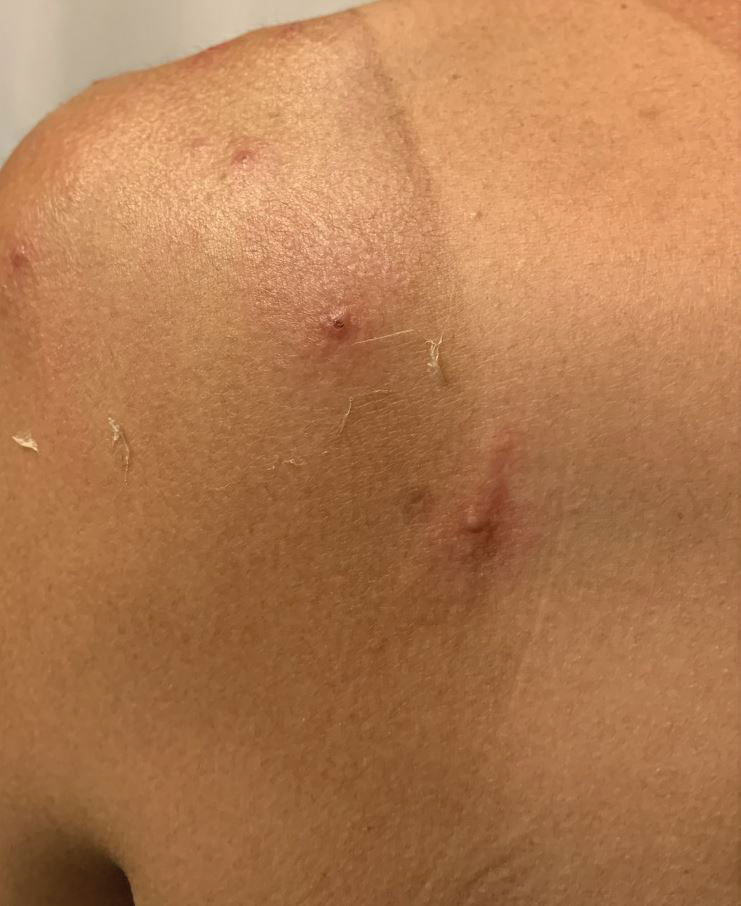 Left shoulder with pustule and pink umbilicated hemorrhagic crusted papules on an erythematous base overlying a background of superficially exfoliating hyperpigmentation with sharp cutoff of sun-protected skin below the shirt. 