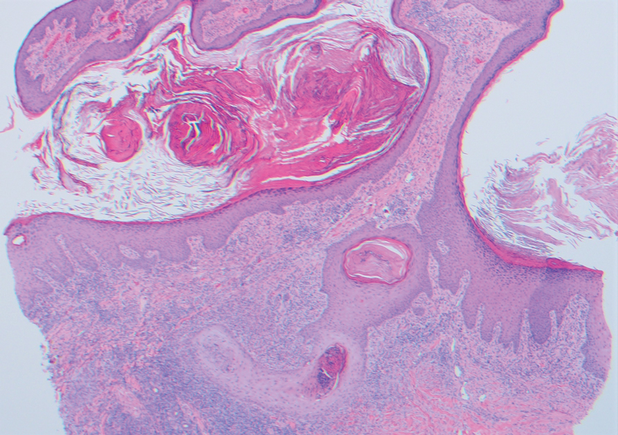 Histopathology demonstrated pseudoepitheliomatous hyperplasia with intraepidermal collections of neutrophils and a dense mixed inflammatory dermal infiltrate