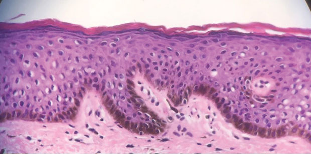 Although histopathology showed increased pigmentation, the number of melanocytes within the epidermis was not increased (H&E, original magnification ×200).