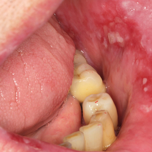 Atrophic-erosive and ulcerative recalcitrant lesions of oral lichen planus after topical and systemic corticosteroid administration