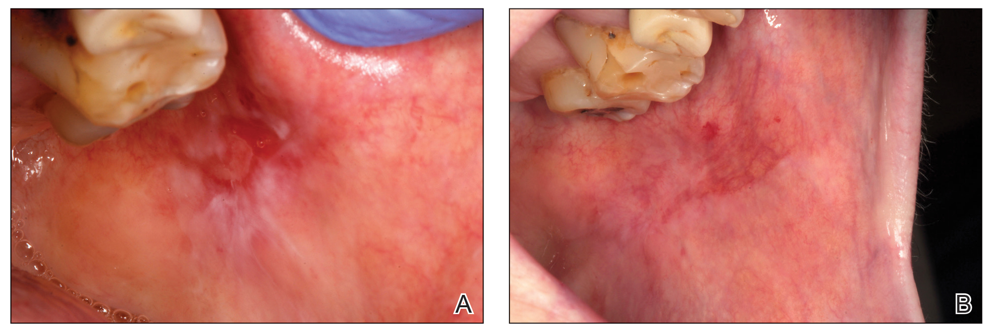 A, An oral lichen planus lesion resistant to treatment with topical and systemic corticosteroids. B, Re-epithelialization 1 week after a single perilesional infiltration with plasma rich in growth factors.