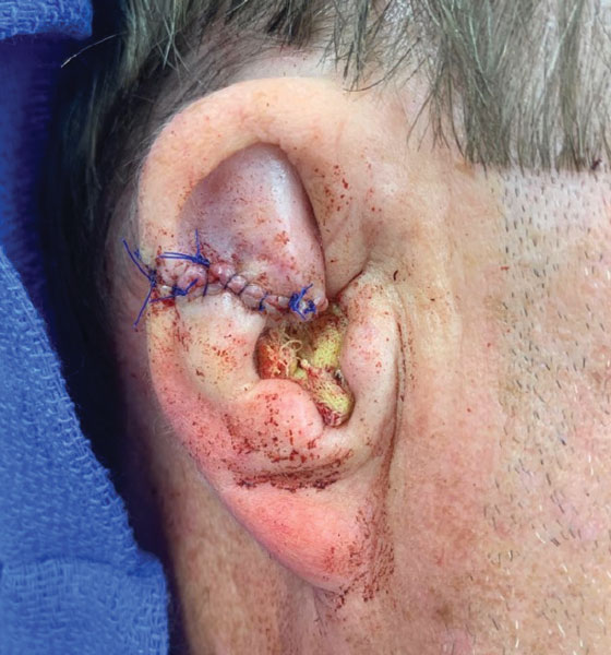 Primary repair of a surgical wound on the right ear.