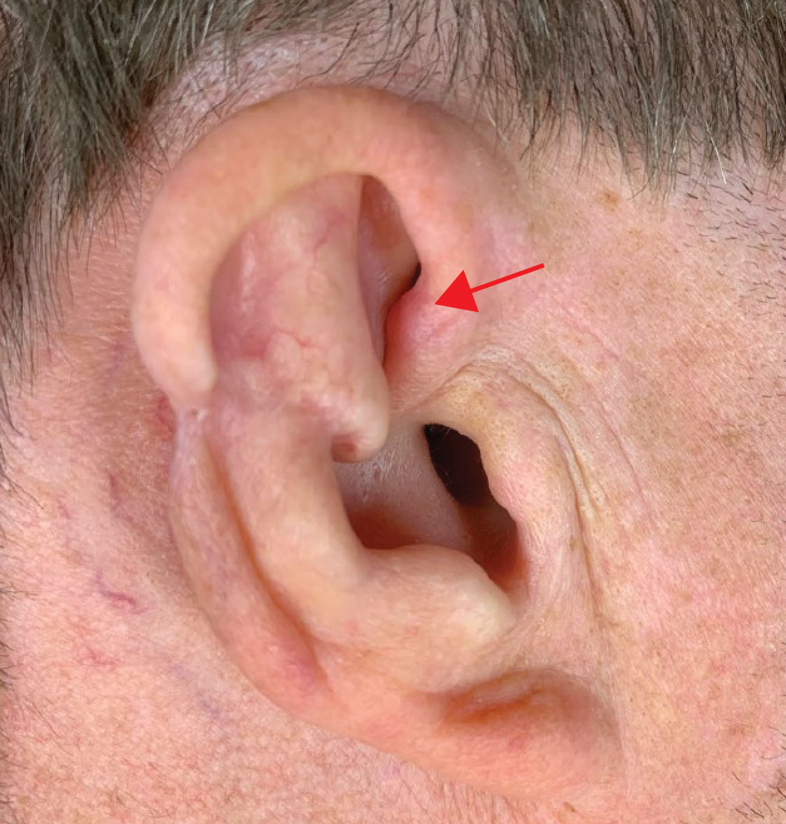 Following radiation therapy, chondrodermatitis nodularis helicis (arrow) developed outside the surgical scar but within the adjuvant radiation portal.