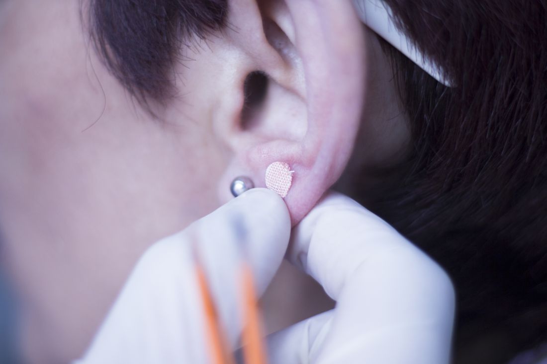 Auriculartherapy ear seed treatment. Courtesy Edward Olive/Dreamstime.com