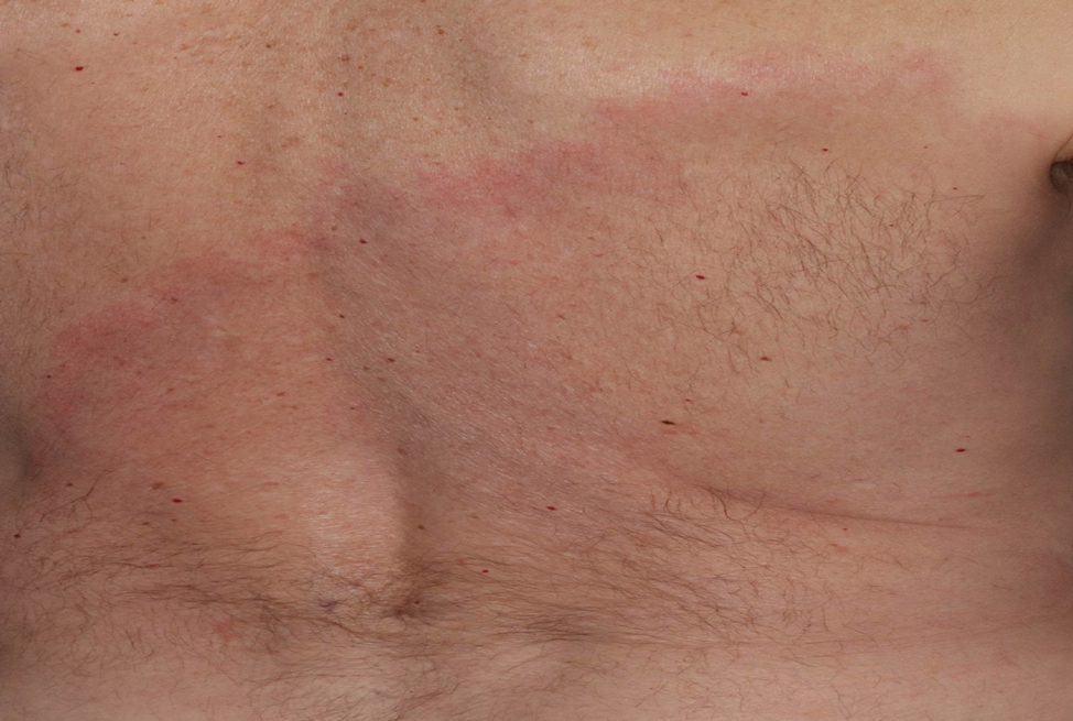 Asymptomatic erythematous plaque in an outdoorsman