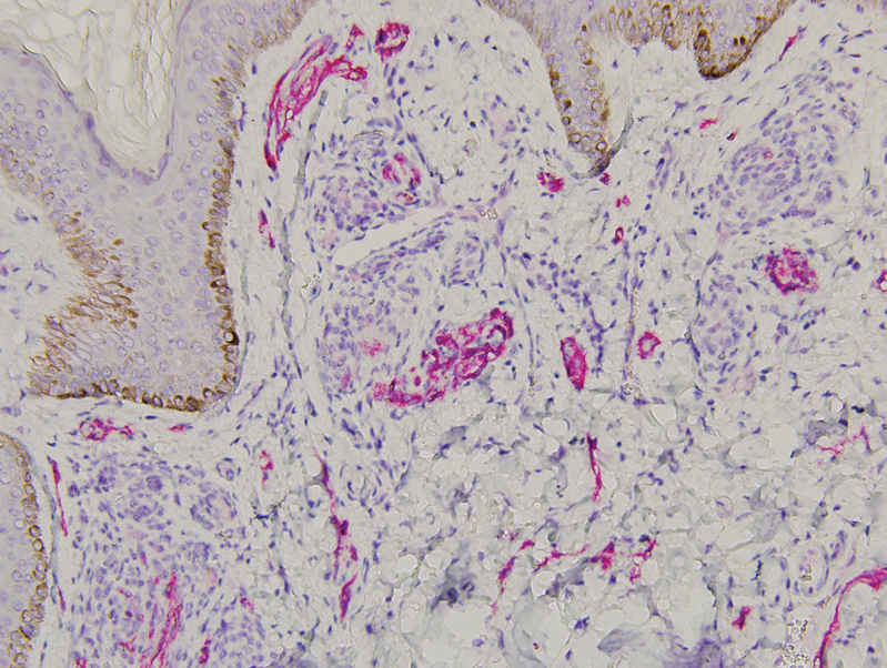 D2-40 immunohistochemical staining of lymphatics surrounding capillary proliferations with an absence of staining of the capillary endothelial cells