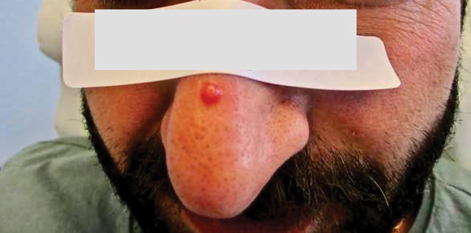 Solitary shiny, 7-mm, pink-red papule on the patient’s nasal dorsum that was diagnosed as nonepidemic Kaposi sarcoma.