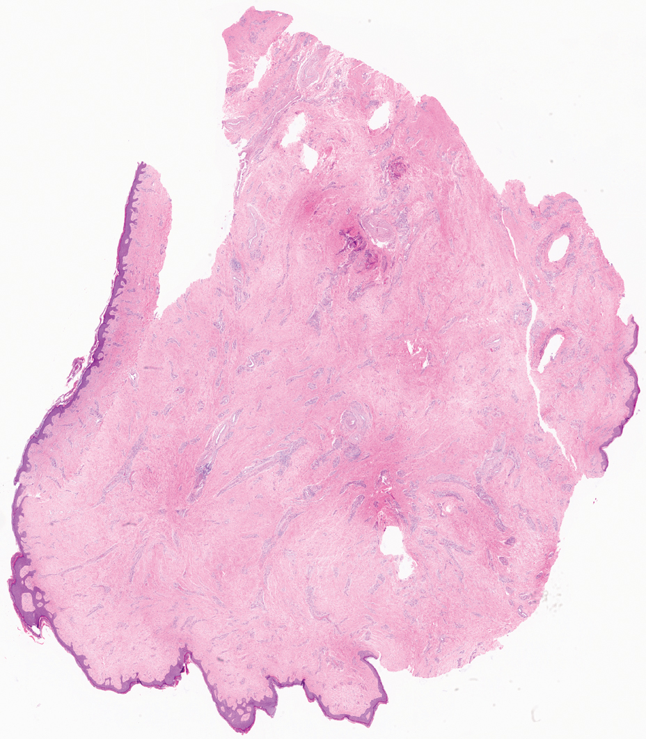 Histopathology revealed fibrovascular tissue with loose and dense collagen fibers and mild epidermal acanthosis characteristic of giant acrochordon (H&E, original magnification ×10).