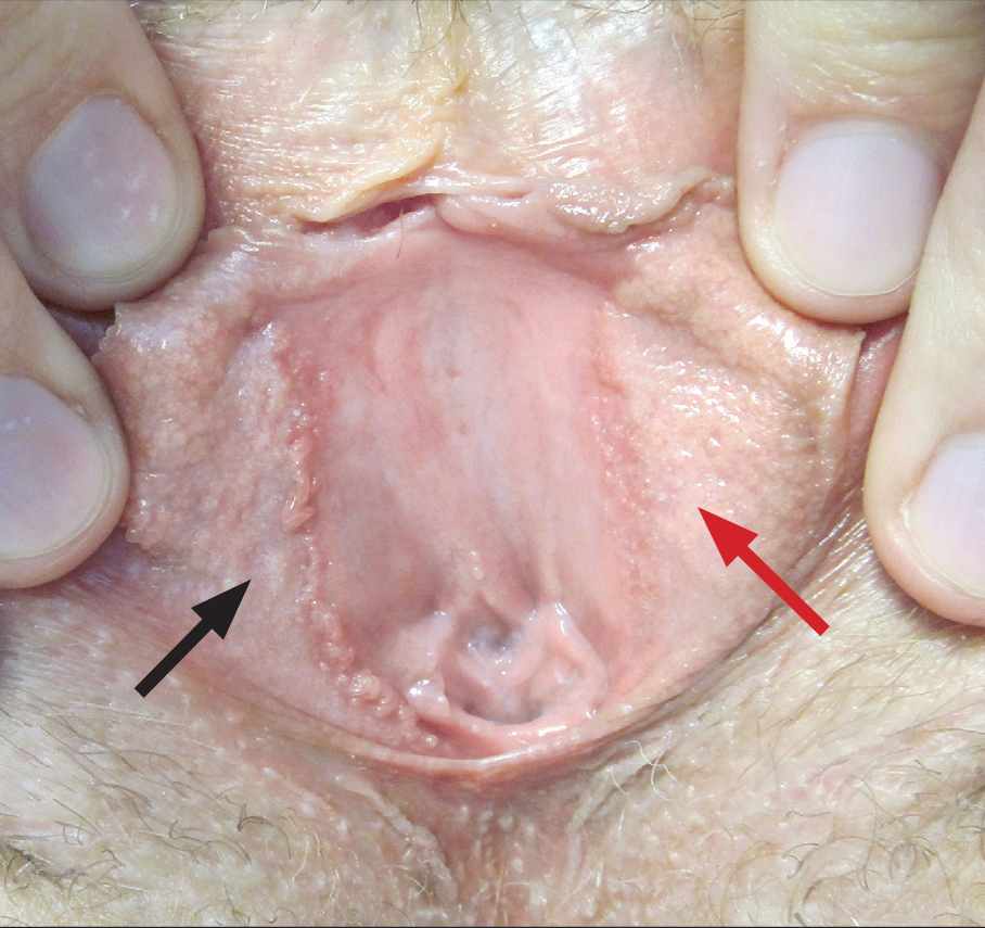 a clitoris condyloma