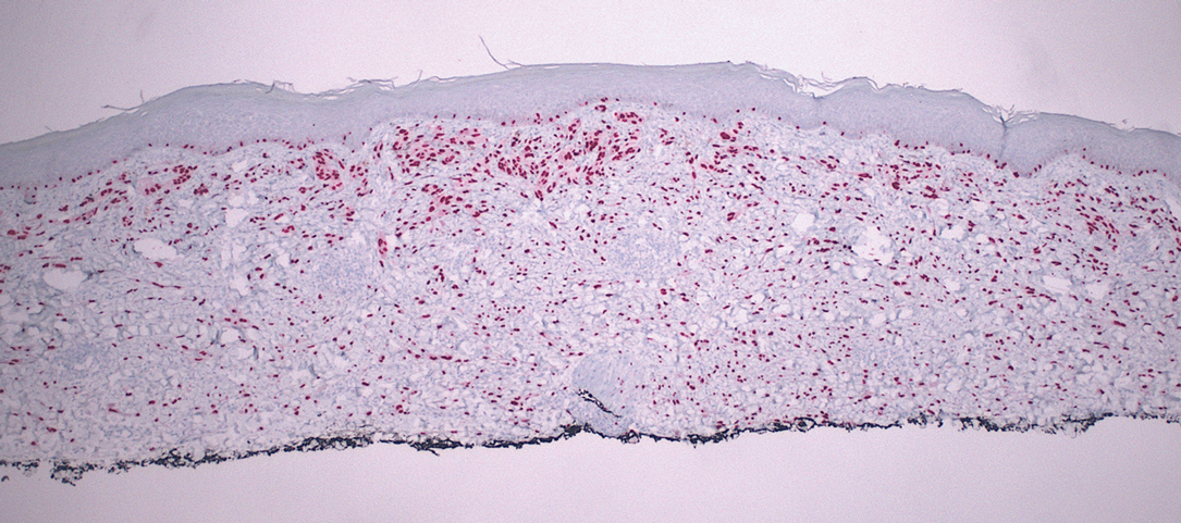 Desmoplastic Spitz nevus. Immunohistochemistry shows a neoplastic proliferation in the dermis with SOX-10 (SRY-related HMG box 10) positivity (original magnification ×40).