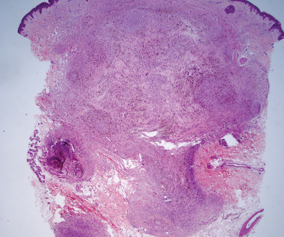 Cellular blue nevus