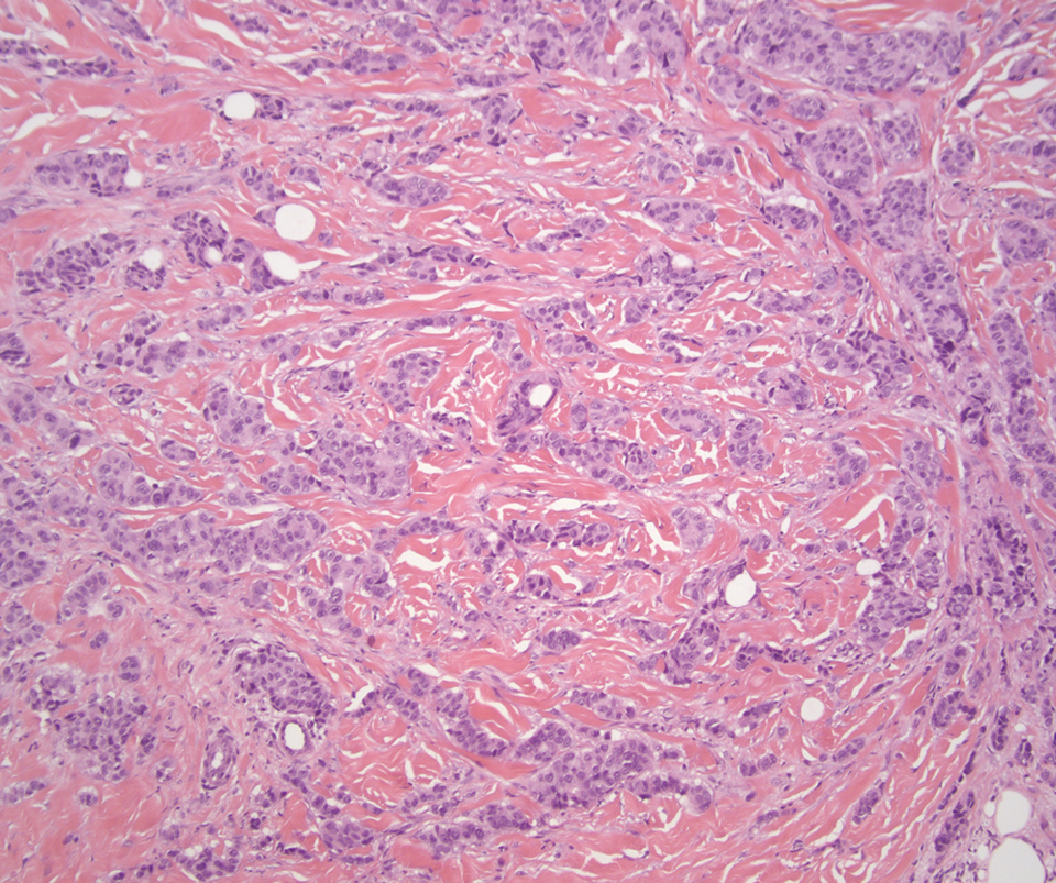 Cutaneous metastatic breast cancer