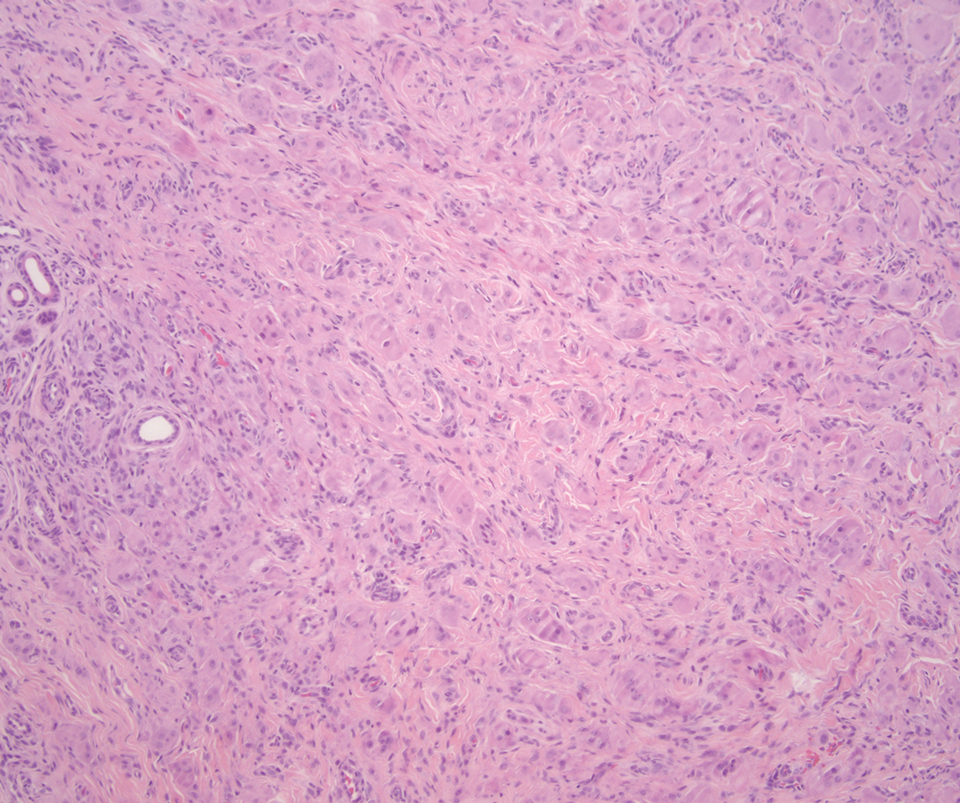 Multicentric reticulohistiocytosis