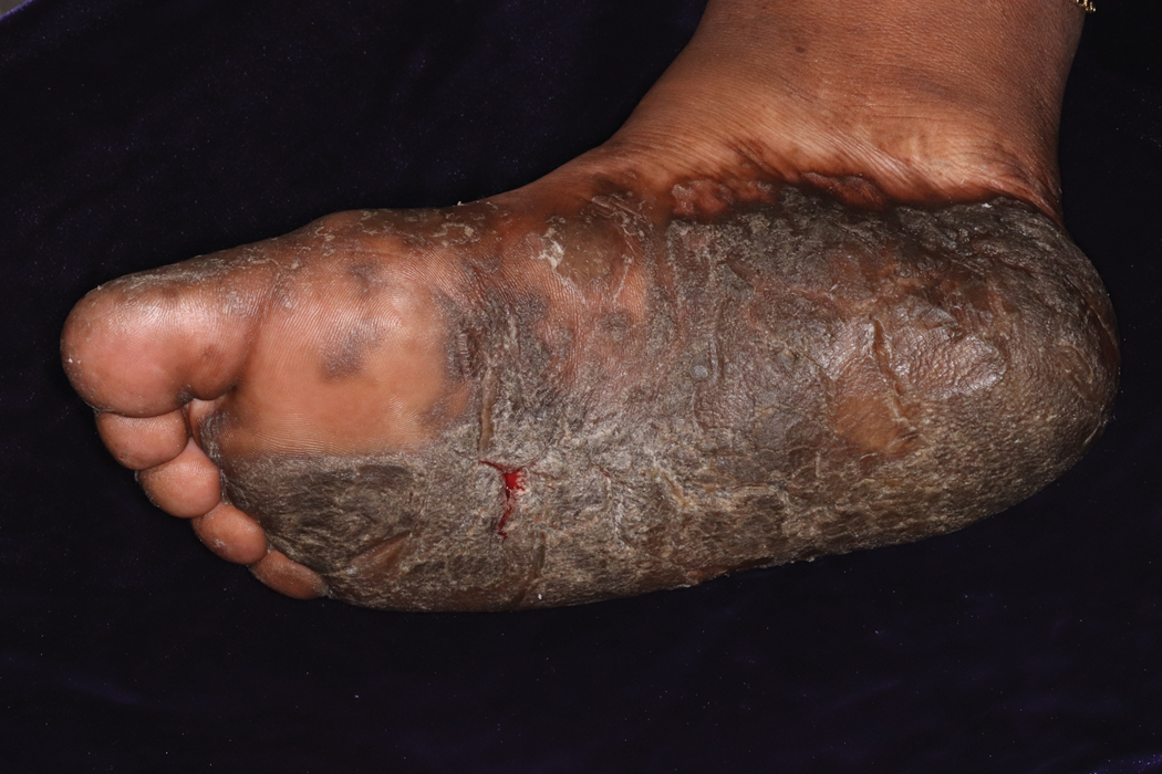 Thick Hyperkeratotic Plaques on the Palms and Soles