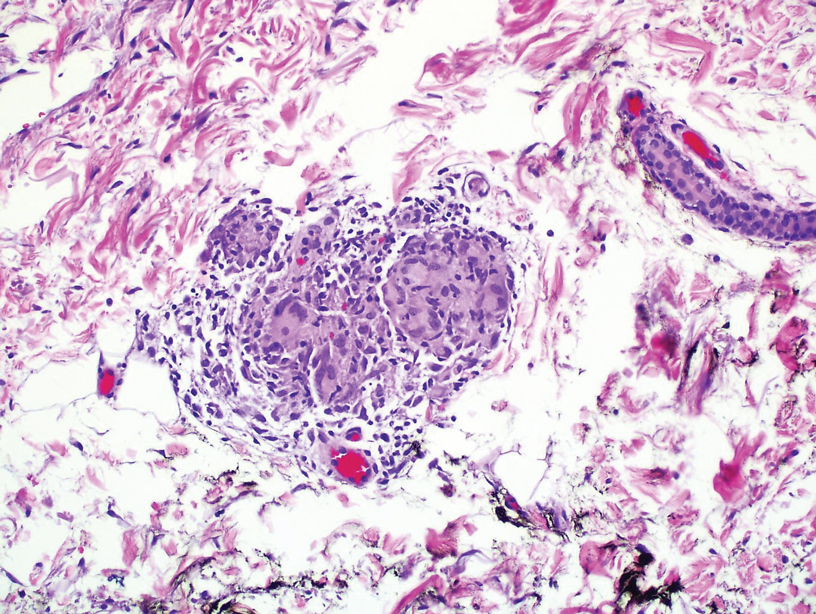 Granulomatous Dermatitis in a Patient With Cholangiocarcinoma