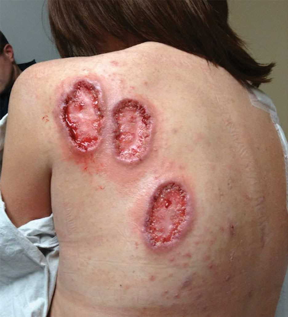 Long-term Remission of Pyoderma Gangrenosum, Acne, and Hidradenitis  Suppurativa Syndrome