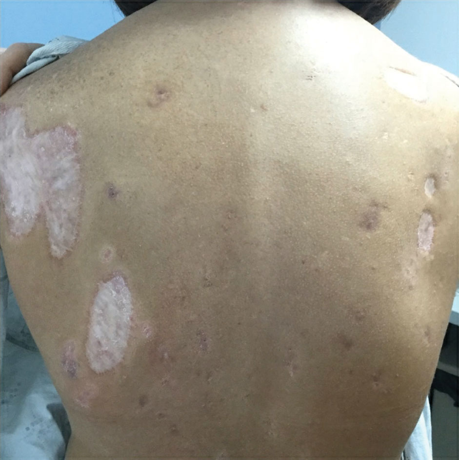 The patient’s pyoderma gangrenosum was controlled with combination therapy with cyclosporine and adalimumab.