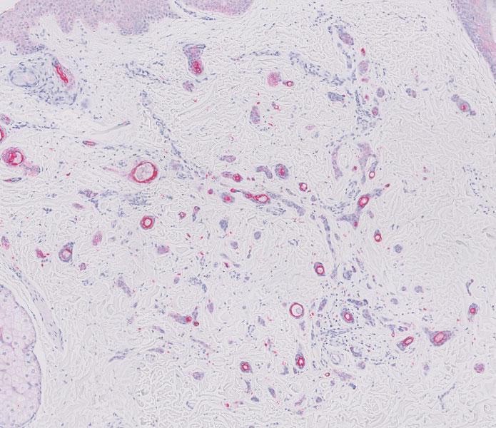 AE1/AE3 cytokeratin immunohistochemical staining highlighted the adnexal proliferation (original magnification ×50).