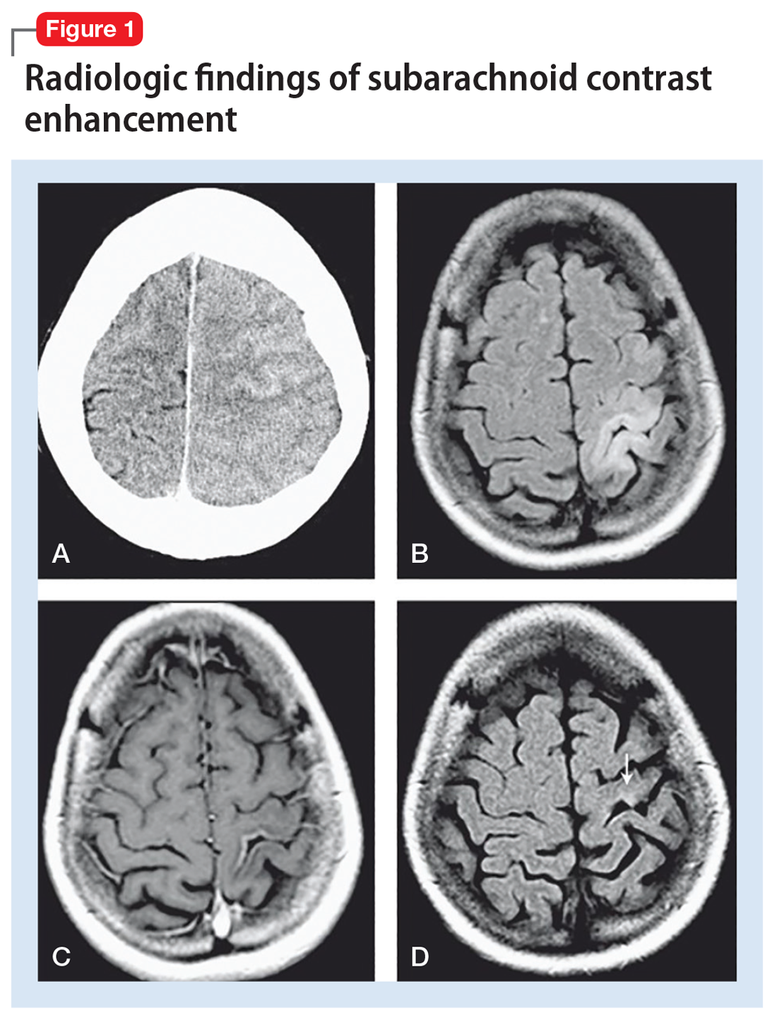 Radiologic findings of subarachnoid contrast enhancement