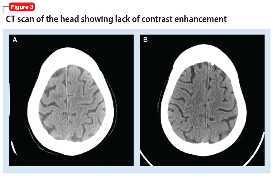 CT scan of the head showing lack of contrast enhancement