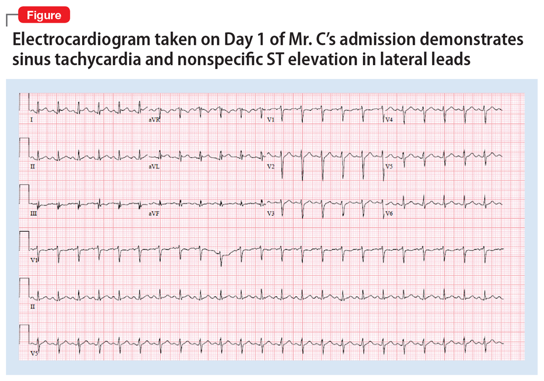 Electrocardiogram taken on Day 1 of Mr. C’s admission demonstrates sinus tachycardia and nonspecific ST elevation in lateral leads