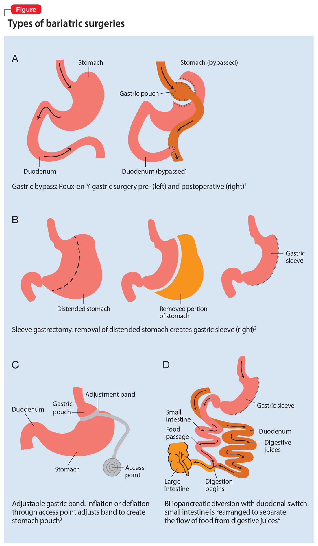 Types of bariatric surgeries