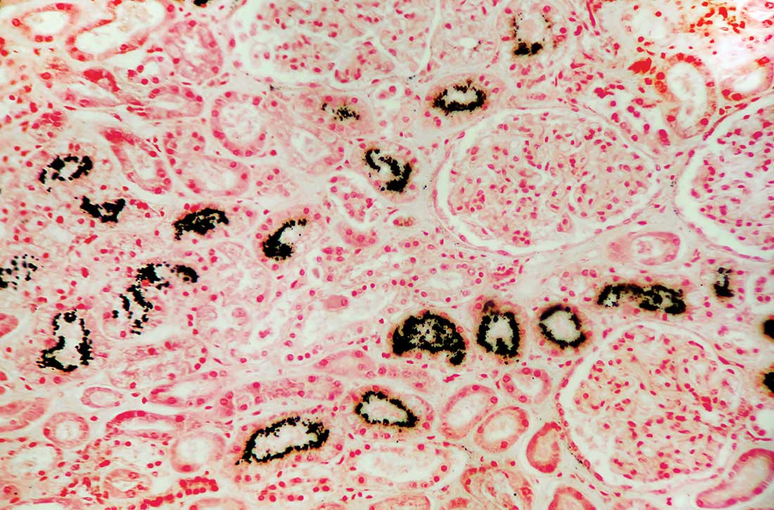 Hypercalcemia