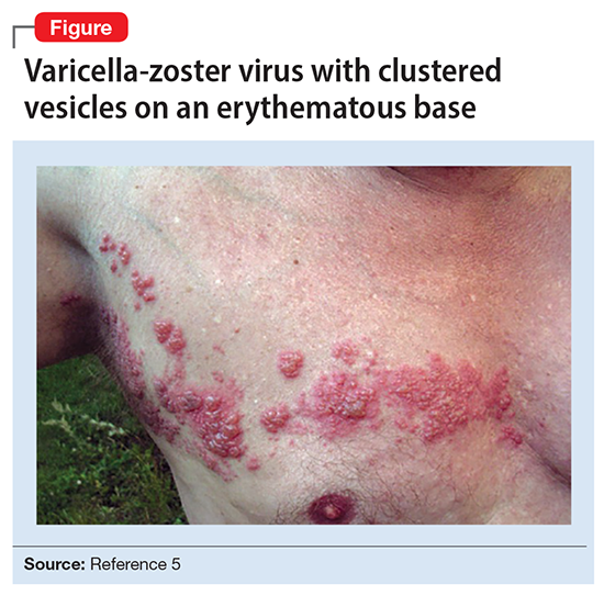 Varicella-zoster virus with clustered vesicles on an erythematous base