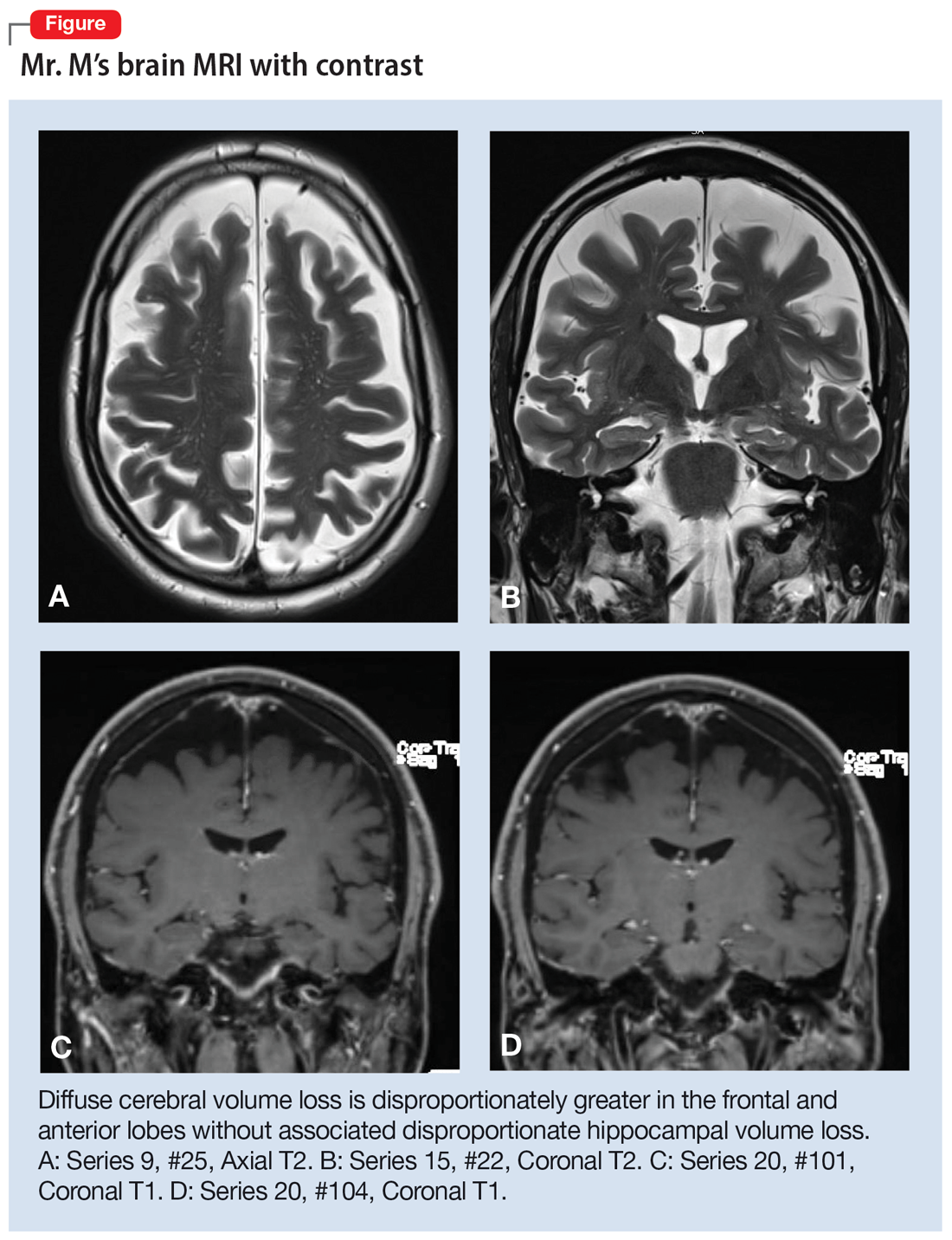 Mr. M’s brain MRI with contrast