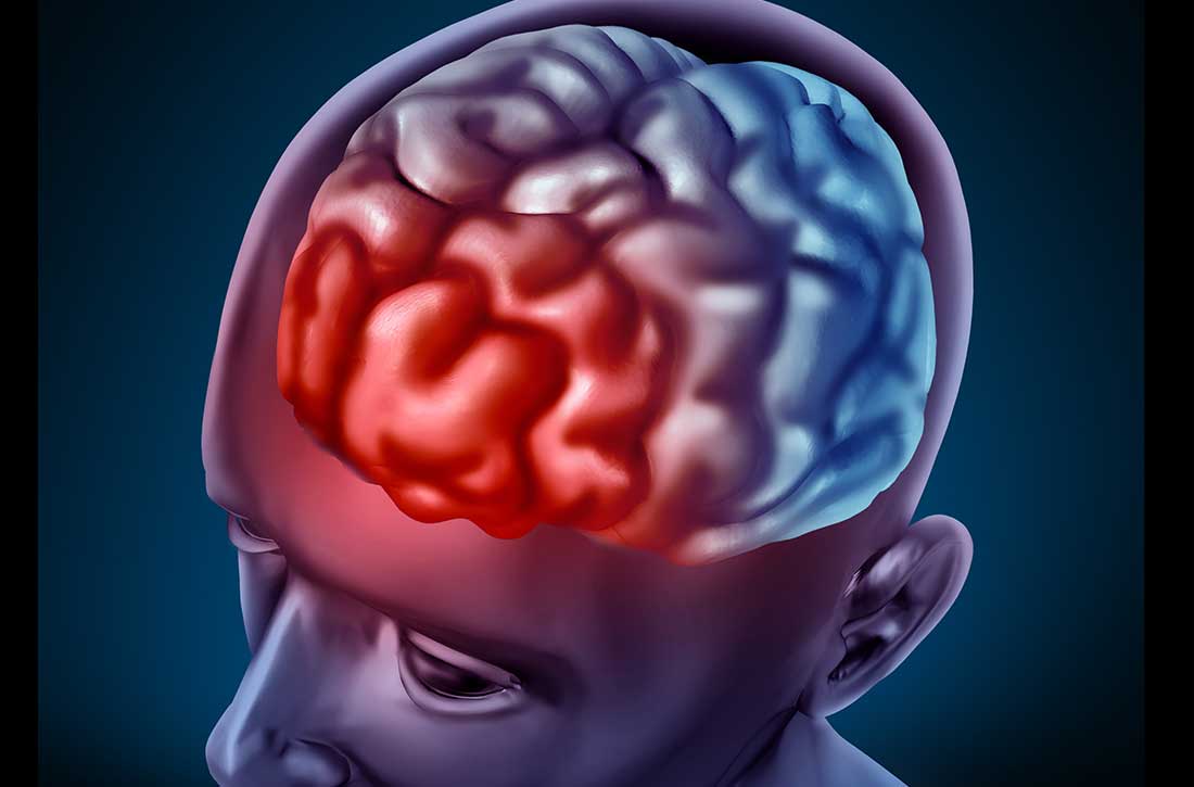 Traumatic brain injury