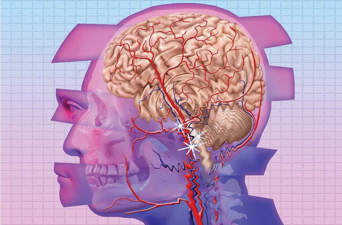 Parkinson's disease 