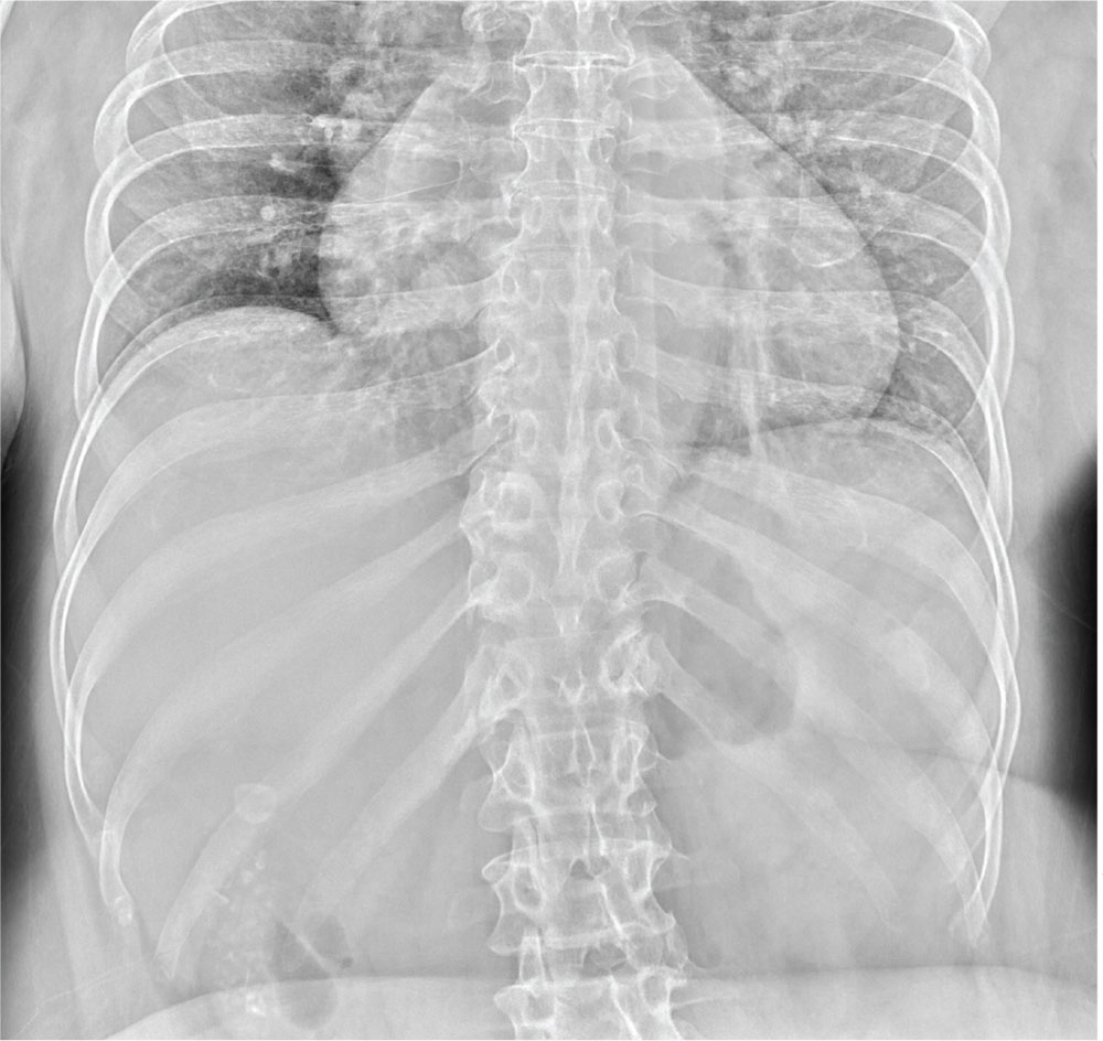 A 60-year-old woman with chronic but worsening abdominal pain presents for evaluation. She does not have a fever but is constipated and occasionally nauseous. What does a radiograph reveal image