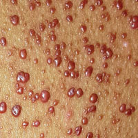 A 12-year-old African-American girl had lesions on her trunk since shortly after birth. Her pediatrician was confident that she would "outgrow" them, but the lesions continue to multiply as she ages. Can you provide a diagnosis image