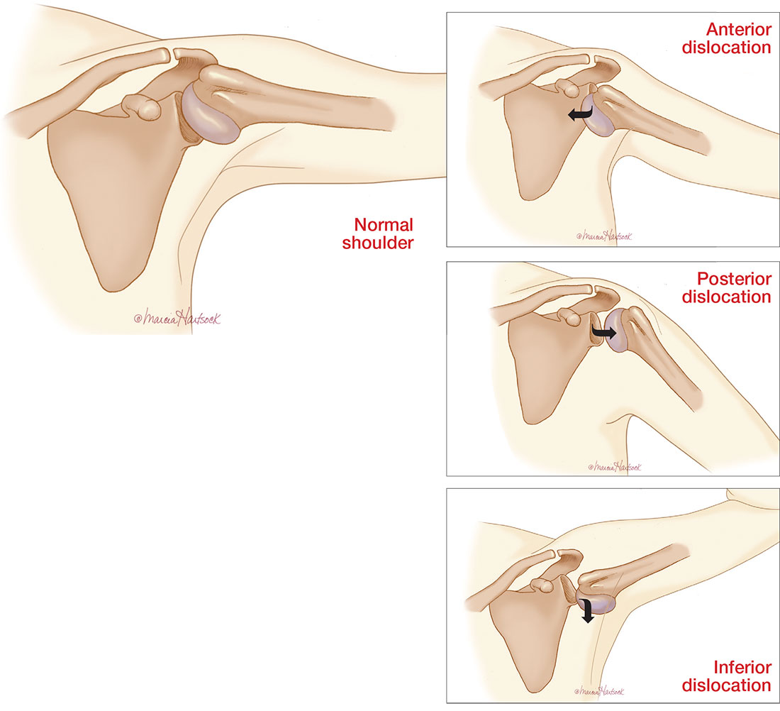 Dislocation of the humerus in any direction may compromise the axillary ner...