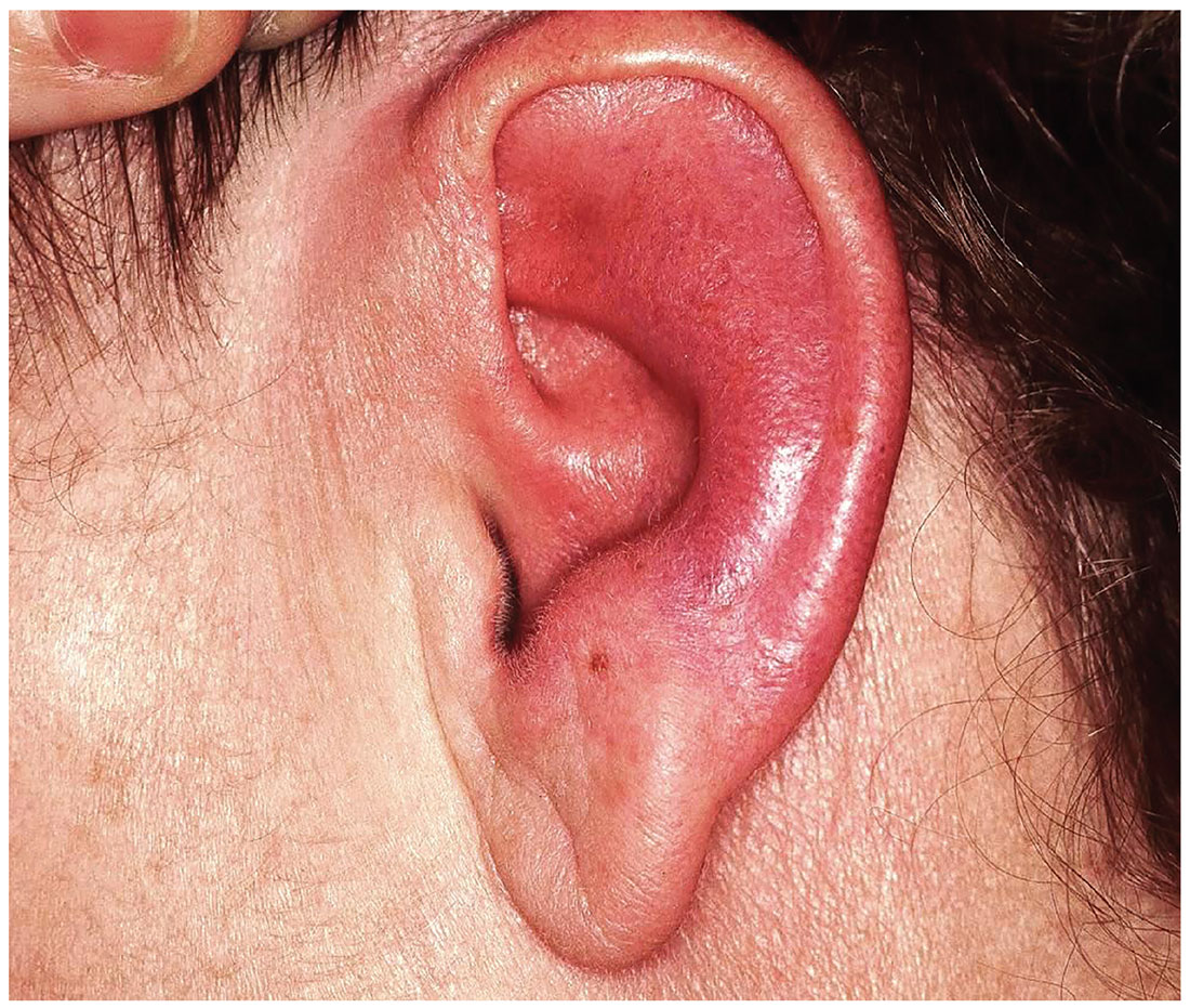 Transformer Misvisende hæk Seeing Redness and Ear-itation | Clinician Reviews